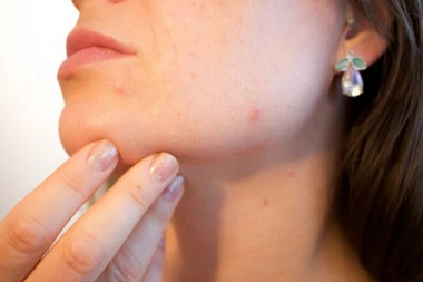 BUBULJICE I BORE: Ozbiljni PROBLEMI sa kožom lica mogu da nastanu, ukoliko NE POŠTUJETE ovo PRAVILO!