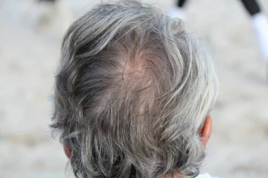 Seda kosa je posledica OVIH životnih navika, ne samo starenja