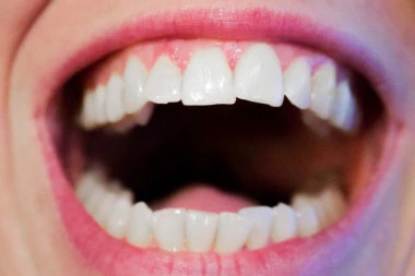 (RECEPT) Imate strah od zubara? Uklonite zubni kamenac kod kuće uz pomoć OVIH magičnih sastojaka