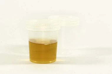 Boja urina reflektuje zdravlje čitavog organizma: Ako primetite jednu važnu promenu, morate odmah kod lekara