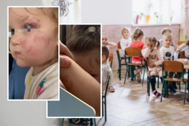 HOROR U SMEDEREVSKOM VRTIĆU: Dete izujedalo vršnjakinju, devojčica HITNO HOSPITALIZOVANA (FOTO)
