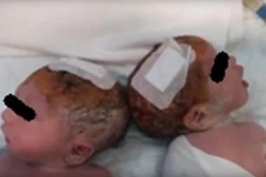 RUSKI HIRURZI BRILJIRALI: Za 30 minuta razdvojili sijamske bliznakinje!