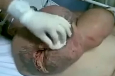 (VIDEO) Bodibilder se predozirao hemijom i RUKA MU JE EKSPLODIRALA