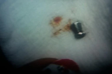 KAO IZ SNAJPERA: Dečaka u Kraljevu pogodio metak iz vazdušne puške u glavu