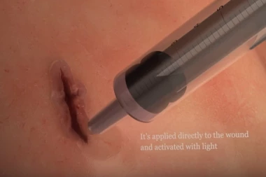 (VIDEO) MEDICINSKO ČUDO: Ovaj lepak zatvara rane!