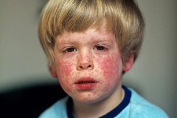 Stručnjaci zabrinuti: Srbija na pragu nove epidemije rubeola, malih boginja i zaušaka, a ovo je glavni krivac za to