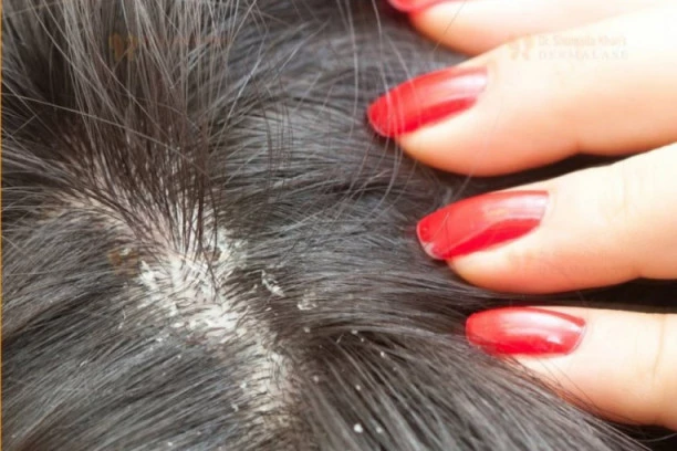 Sprečite perut i opadanje kose: Najbolji su prirodni preparati, evo kratkog vodiča