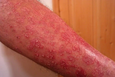JOGURT SA SUSAMOM PROTIV PSORIJAZE: Izlečite iritantne ljuspice na koži prirodnim putem