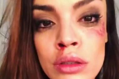 UZNEMIRUJUĆE: Sofija Rajović u modricama!