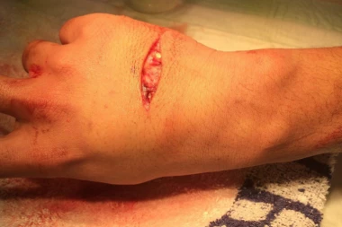 JEZIVA SCENA: Ušao KRVAV u taksi BEZ RUKE, NAŠLI je u KANTI