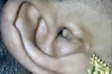 (VIDEO) UŽAS SVIH UŽASA: Živ pauk se uvukao u uvo i stvarao nepodnošljive bolove