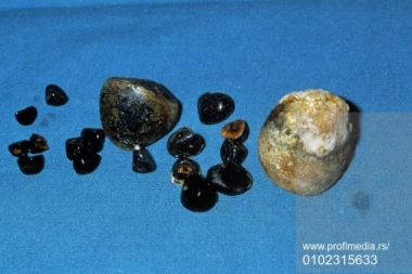 HIT PRIČA Bizarna krađa u novogodišnjoj noći: Ukrali kamen iz žučne kese