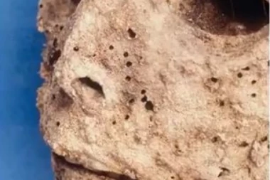 ZASTRAŠUJUĆI PODACI ZA ČOVEČANSTVO: Pronađena MUMIJA IZ 16 VEKA, bolovala od hepatitisa B!