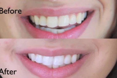 (VIDEO) Izbelite zube za samo dva minuta, sastojke već imate u kući!