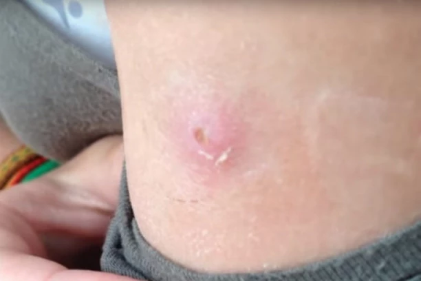 Ovo su PRIRODNI MELEMI koji će ukloniti bradavice očas posla!