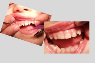 Nikada nije zabeleženo ništa slično: Kad su videli šta ovaj dečak ima u ustima stomatolozi se zabezeknuli!