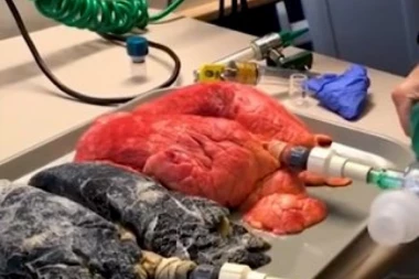 ZASTRAŠUJUĆI PODACI: U Srbiji 12 ljudi dnevno umre od raka pluća