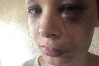 (UZNEMIRUJUĆ SADRŽAJ) HOROR: Prebijena trudnica Anđela (20), Šiptar je tukao jer nije htela se*s sa njim!