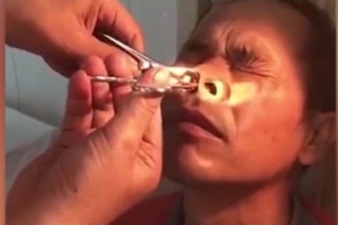 OTPORNI STE NA BLJUVOTINE? Pogledajte kakvu je GADOST lekar izvadio pacijentu iz nosa - pa razmislite ponovo!