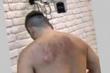 AUUU! Sloba ponovo ima modrice nalik onima koje je zadobio od Lune u "Zadruzi", fanovi zabrinuti!