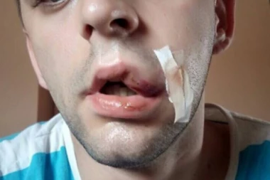 UZNEMIRUJUĆI PRIZOR: Ovako izgleda policajac kojeg su pretukli protestanti na Ibarskoj!