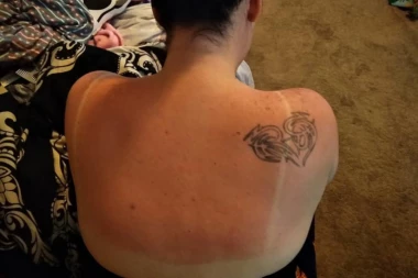 Izgoreli ste na suncu? Isprobajte ove kućne lekove