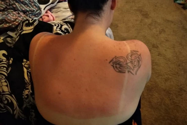 Izgoreli ste na suncu? Isprobajte ove kućne lekove