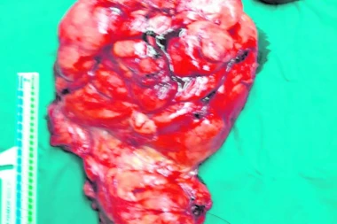LEKARI NA VMA IZVELI ČUDO: Izvadili tumor od 25 kilograma, niko u inostranstvu nije smeo to da uradi!