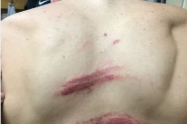 (FOTO) VRANJANCI NISU BILI NEŽNI: Ovako izgledaju leđa Marka Jankovića posle utakmice!