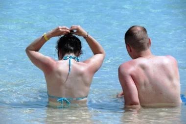 IZGORELI STE NA SUNCU? Ovako ćete za pola sata skroz oporaviti kožu!