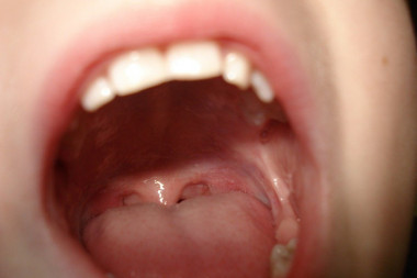 (FOTO) Lekari kapitalirali pred ovom neobičnom šojavom: Ženi rastu dlake u ustima