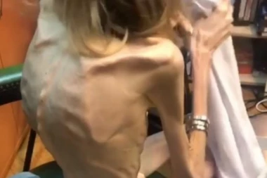 (VIDEO) UPLAŠIĆETE SE! Ova devojka ima 17 KILA - doktor je rekao da treba da bude u HOROR FILMU!