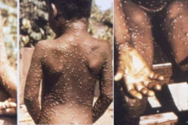 OD MAJMUNSKIH BOGINJA NEMA LEKA, EVO KAKO DA SE ZAŠTITITE