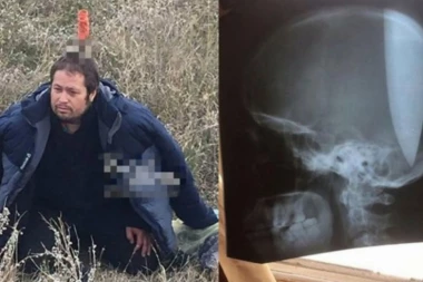(VIDEO) OD OVOGA VAM NEĆE BITI DOBRO! Zario nož u lobanju, a razlog tome je NAJBIZARNIJI na svetu!