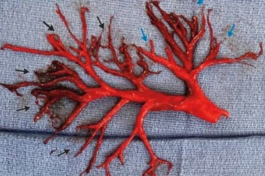 (FOTO) Nije za one sa osetljivim stomakom: Kada budete videli šta je ovaj čovek iskašljao, biće vam muka!