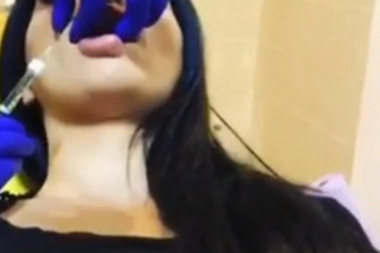 SMEHOTRES: Kada je previše hijalurona u usnama (VIDEO)