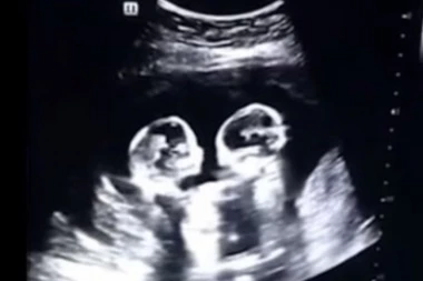 (VIDEO) Bliznakinje iz maminog stomaka postale zvezde na internetu: Kada pogledate video, biće vam jasno i zašto!