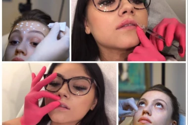 PAMET U GLAVU! Od filera može da se oslepi: Ministarstvo izdalo UPUTSTVO, ovo morate da znate o kozmetičarkama i salonima!