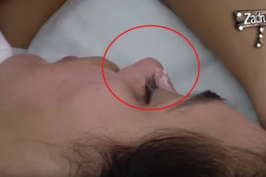 ŠTA JE BRE OVO? Čudna bela smesa i mitiseri buknuli na nosu Ane Korać!