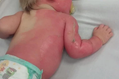 HOROR U LESKOVCU! Dvogodišnji dečak se polio vrelom vodom sa šporeta: HITNO PREBAČEN U KC NIŠ