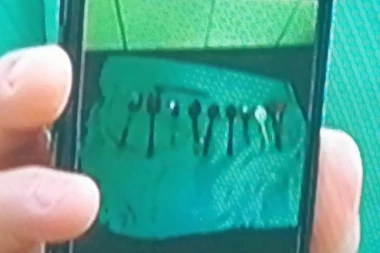 (FOTO) Lekari u Urgentnom zanemeli od šoka! Rekao da ga boli stomak jer je progutao nešto metalno - našli mu 9 KAŠIKA i ČETKICU ZA ZUBE!