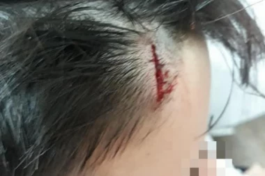 (FOTO) Detetu razbio glavu o klupu pred nastavnicom! Godinama trpi nasilje, a ima problema sa srcem