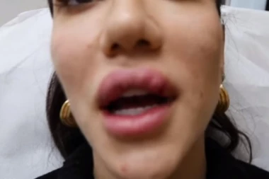 (UZNEMIRUJUĆI VIDEO) Isplivao snimak: Poznata blogerka krvari dok joj smanjuju usne!