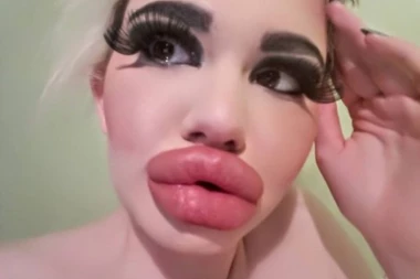 (FOTO) ŠTA ONA ZNA ŠTA JE LEPO! Želi da ima usne kao njen idol, sad su 3 puta veće!