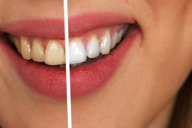 Napravite sami pastu za izbeljivanje zuba: Kombinacije ovih sastojaka su veoma efikasne u "borbi" za blistav osmeh!