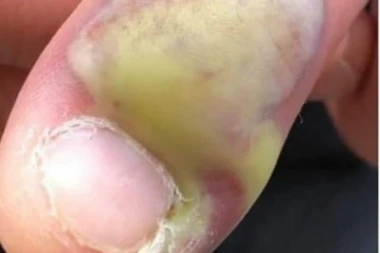 (FOTO) OVO je valjda dovoljno upozorenje da ne grizete nokte?! Zbog ove ružne navike žena je ugrozila svoje zdravlje