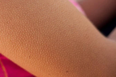 Plašite se sitnih bubuljica po rukama? Evo koja bolest izaziva ovo stanje na koži