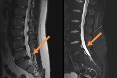 Izbegnite operaciju diskusa i rizike koje ona nosi