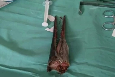 (FOTO) UZNEMIRUJUĆE! Dok je pecao, iz vode je iskočila riba i zarila se tinejdžeru u VRAT!
