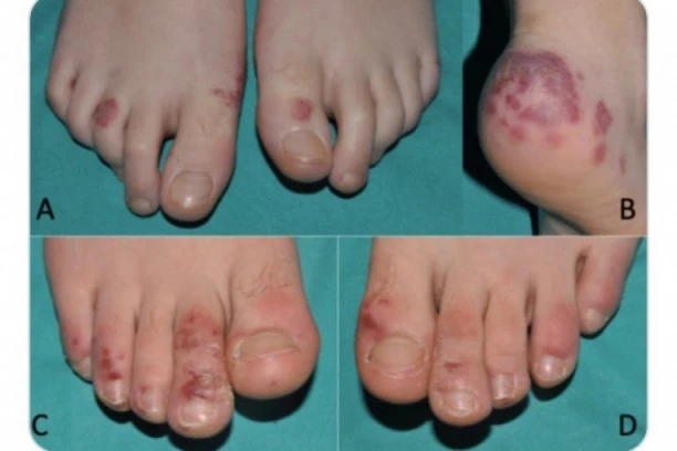 SVAKI 11. PACIJENT IMA OVAJ SIMPTOM: Obratite pažnju na promene na koži, mogu da ukažu na KORONU!